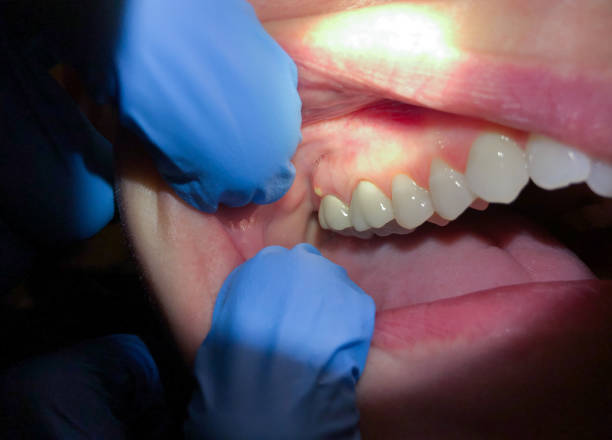 Best Emergency Dentist for Knocked-Out Tooth in Wernersville, PA