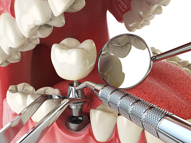 Best Emergency Dentist for Lost Fillings or Crowns in Wernersville, PA